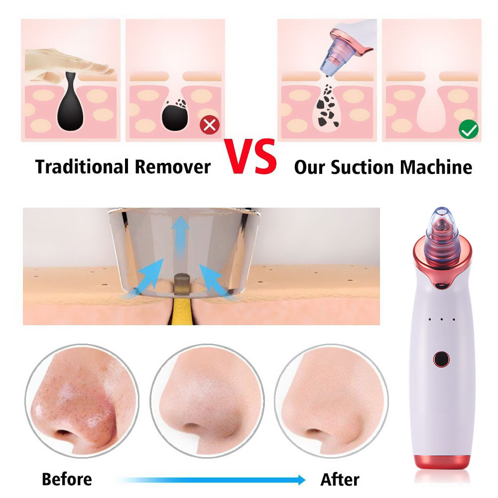 Electric Acne & Blackhead Remover — USB Suction Pore Cleansing Tool | PEACHBXX